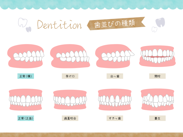 不正咬合 歯並びの種類